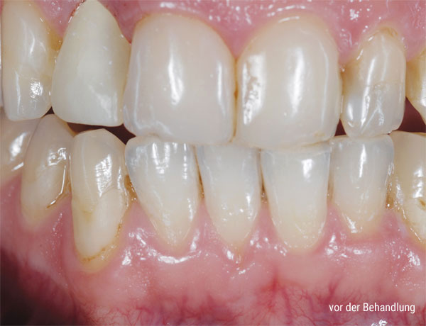 Zähne vor der Behandlung